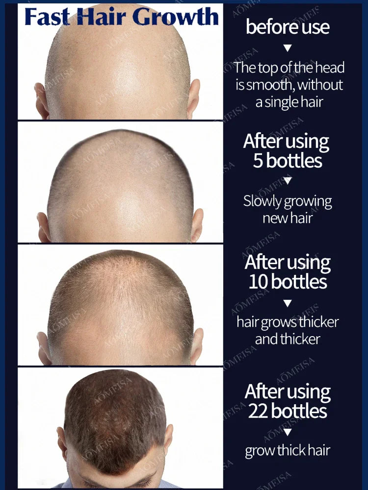 Want to say goodbye to hair loss? Our hair growth products can penetrate the scalp, promote hair growth, and help you regain you