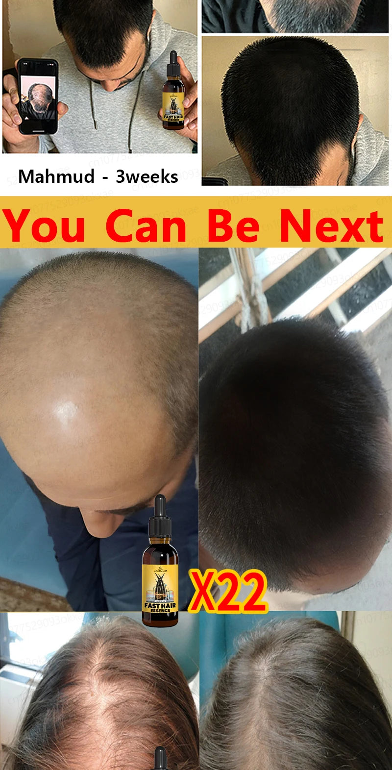 Want to say goodbye to hair loss? Our hair growth products can penetrate the scalp, promote hair growth, and help you regain you