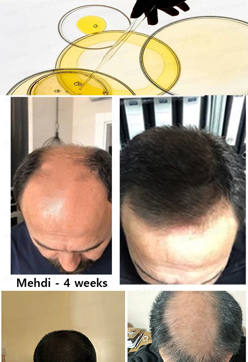 Want to say goodbye to hair loss? Our hair growth products can penetrate the scalp, promote hair growth, and help you regain you