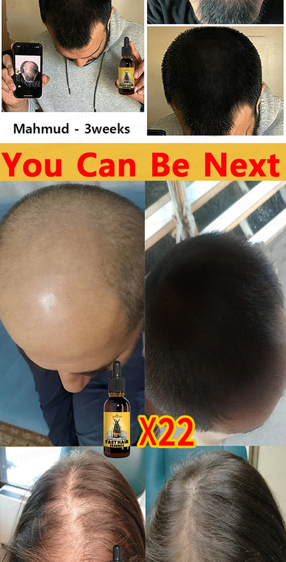 Want to say goodbye to hair loss? Our hair growth products can penetrate the scalp, promote hair growth, and help you regain you