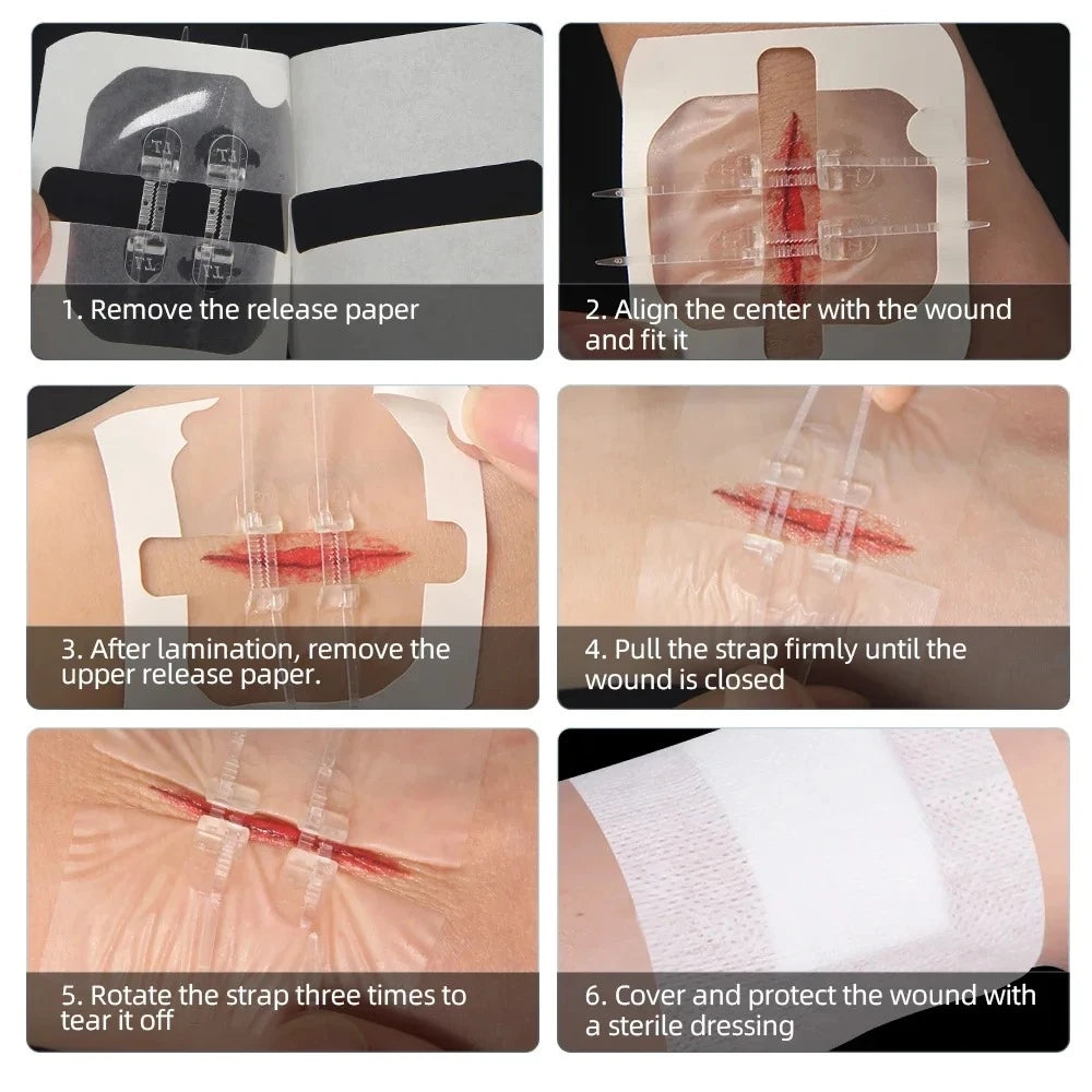 2-10 adhesive bandages with zipper, wound closure device, no need for sutures, quick and painless, outdoor medical care